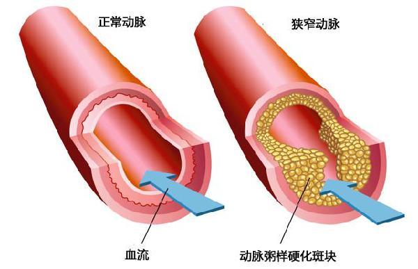 哪些人容易得血栓？